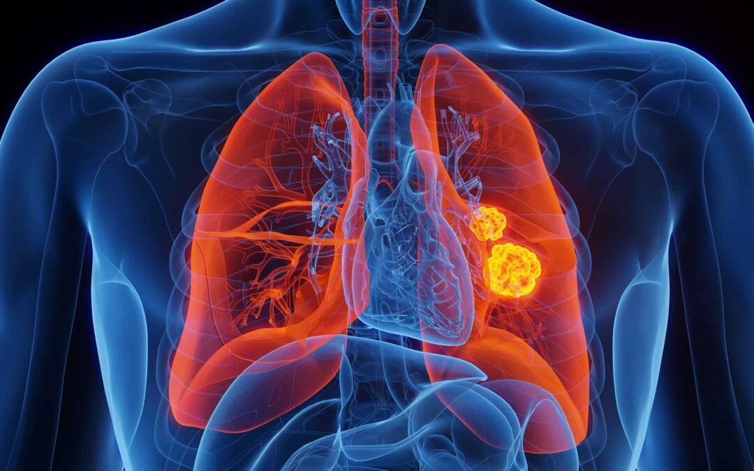 Día Mundial del Cáncer de Pulmón: una oportunidad para reflexionar, prevenir y acompañar