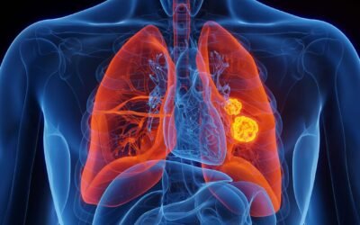 Día Mundial del Cáncer de Pulmón: una oportunidad para reflexionar, prevenir y acompañar